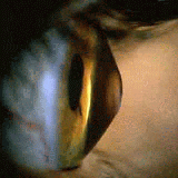 Conical Cornea