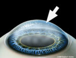 Damaged Cornea