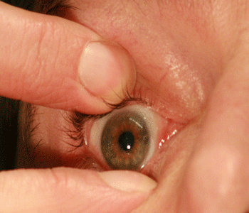 SiH Lens removal technique